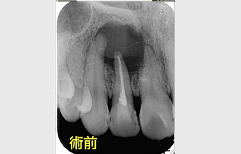 「治療した歯が痛む」と悩む患者さんの根管治療の症例