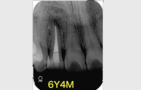 「治療した歯が痛む」と悩む患者さんの根管治療の症例