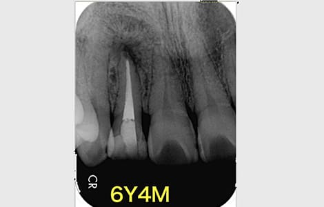 「治療した歯が痛む」と悩む患者さんの根管治療の症例