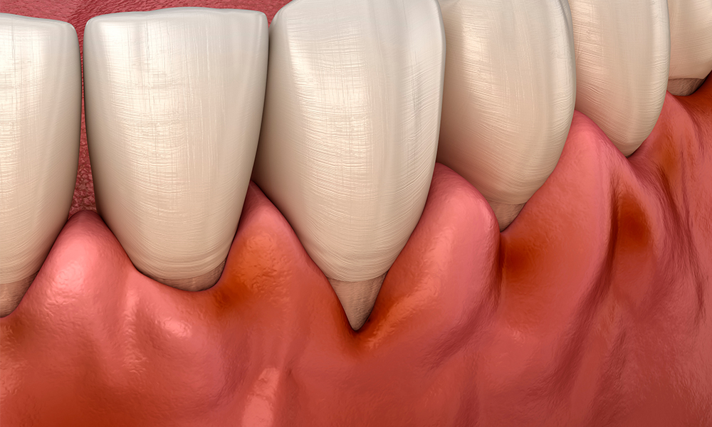 大切な歯を失わせる最大の原因　歯周病