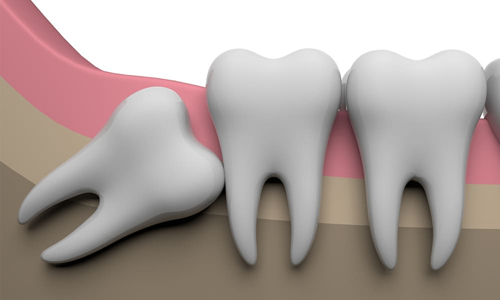 専門家対応親知らずの抜歯