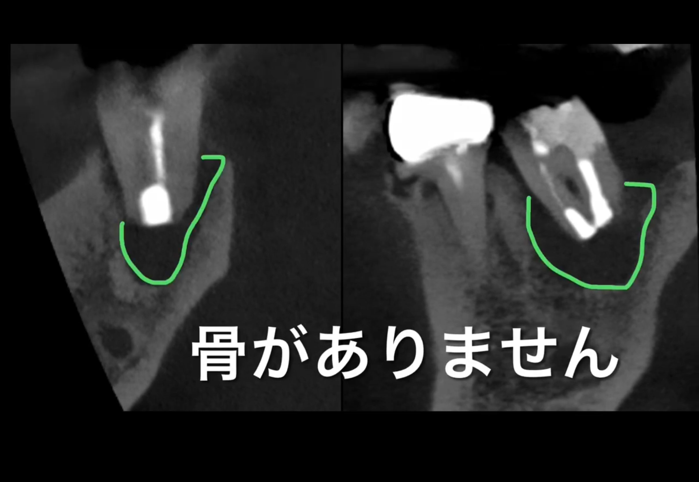 「何度も腫れる奥歯…抜歯しかない？治療法を徹底解説」
