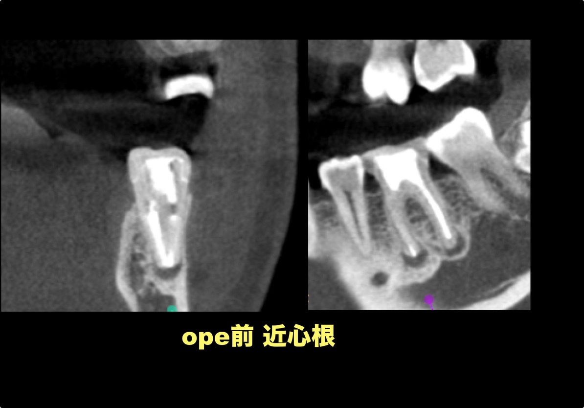 【術前】近心根と遠心根のCT画像