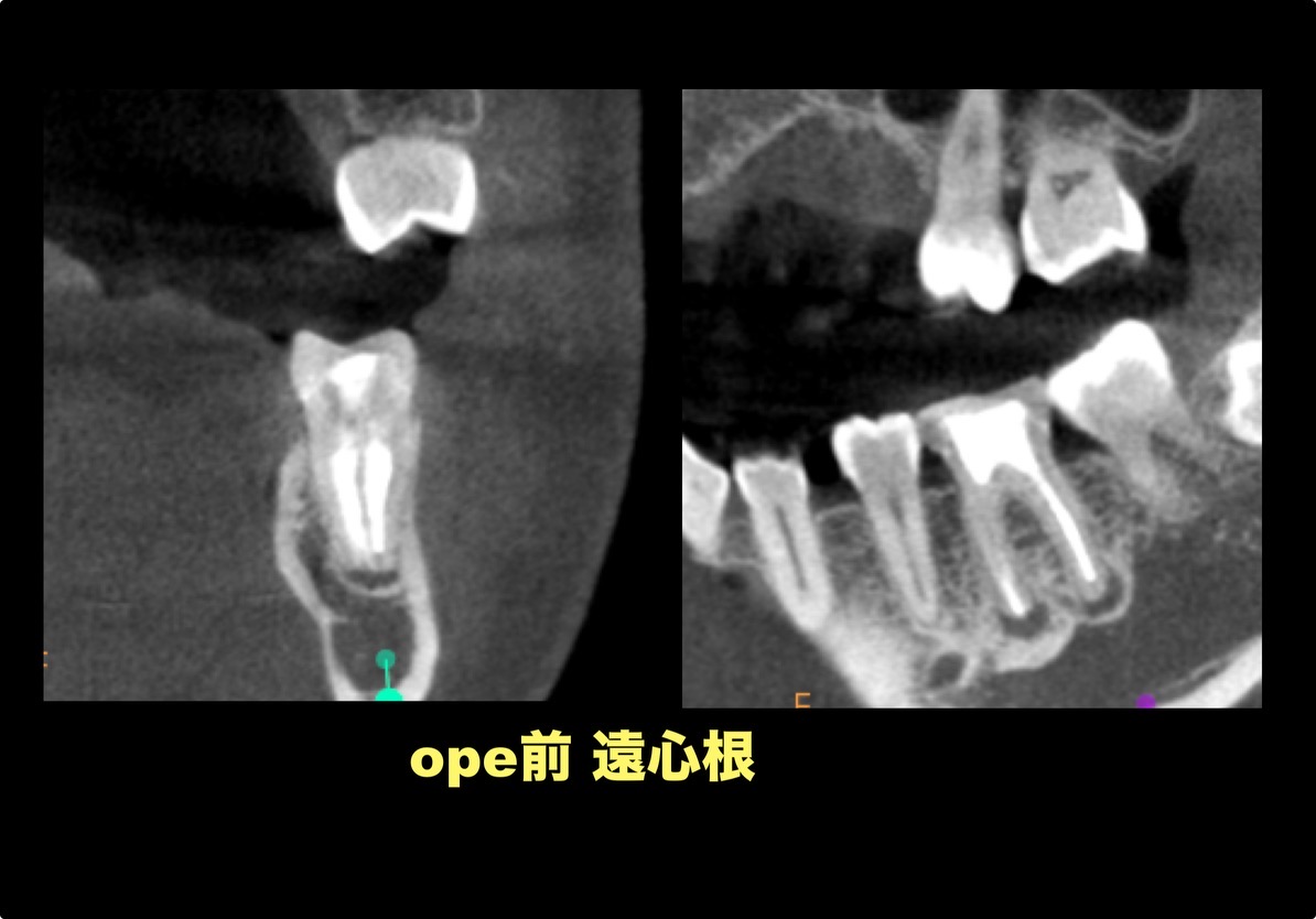【術前】近心根と遠心根のCT画像
