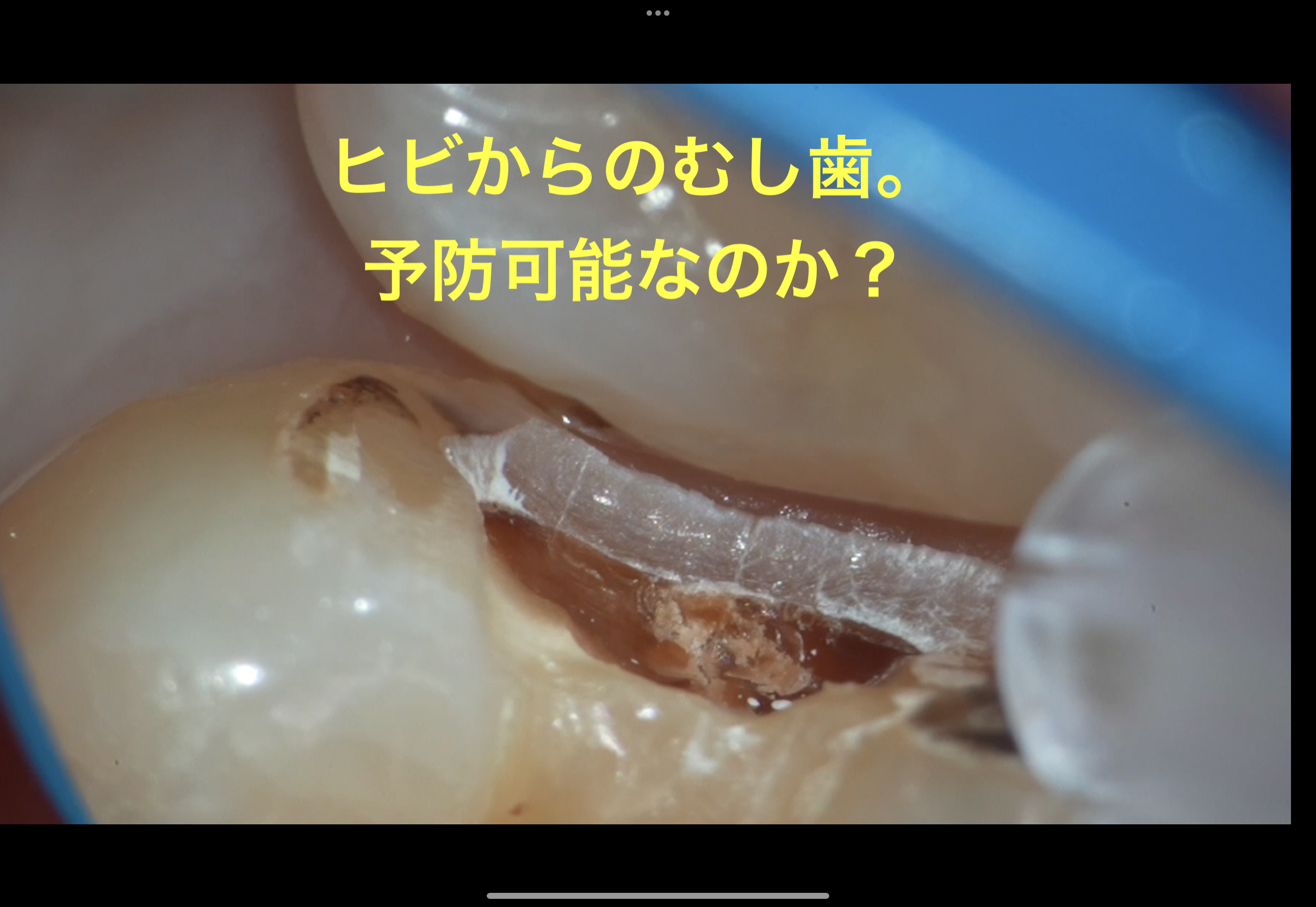 歯と歯の間のむし歯。予防できる？