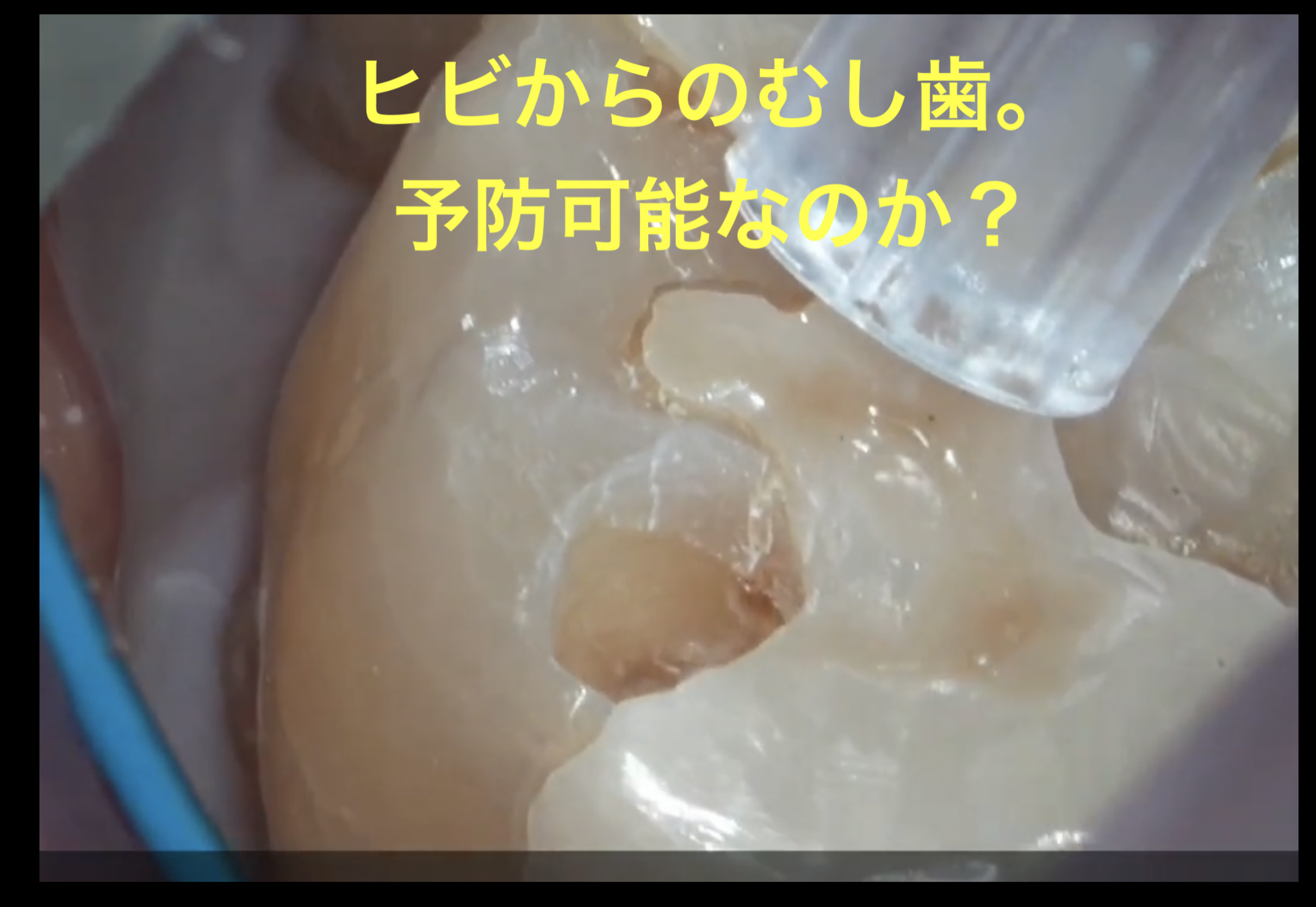 咬合面(咬むところ)のむし歯治療。予防可能なのか？