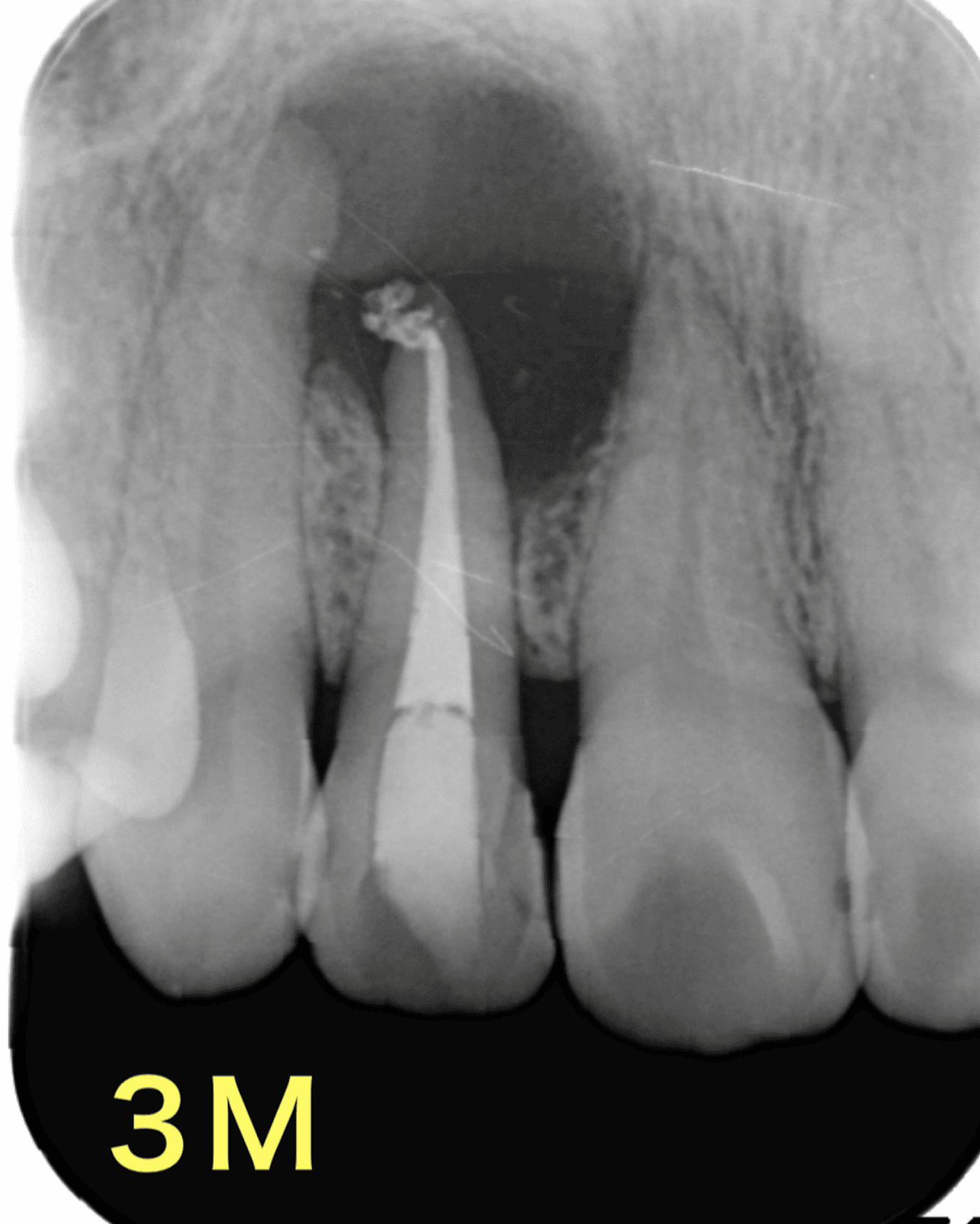 再根管治療８年後の経過