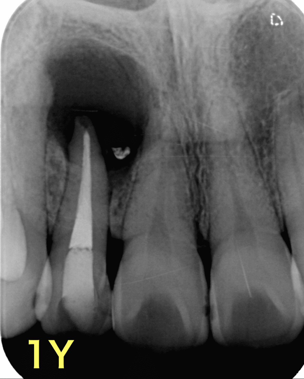 再根管治療８年後の経過