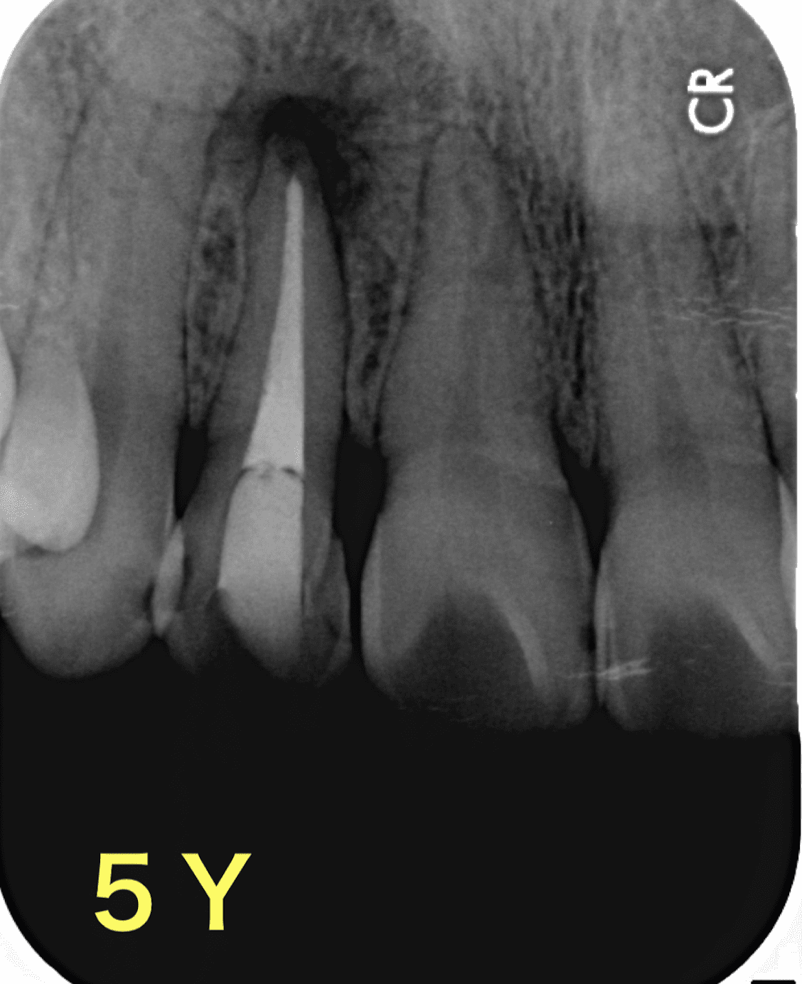 再根管治療８年後の経過