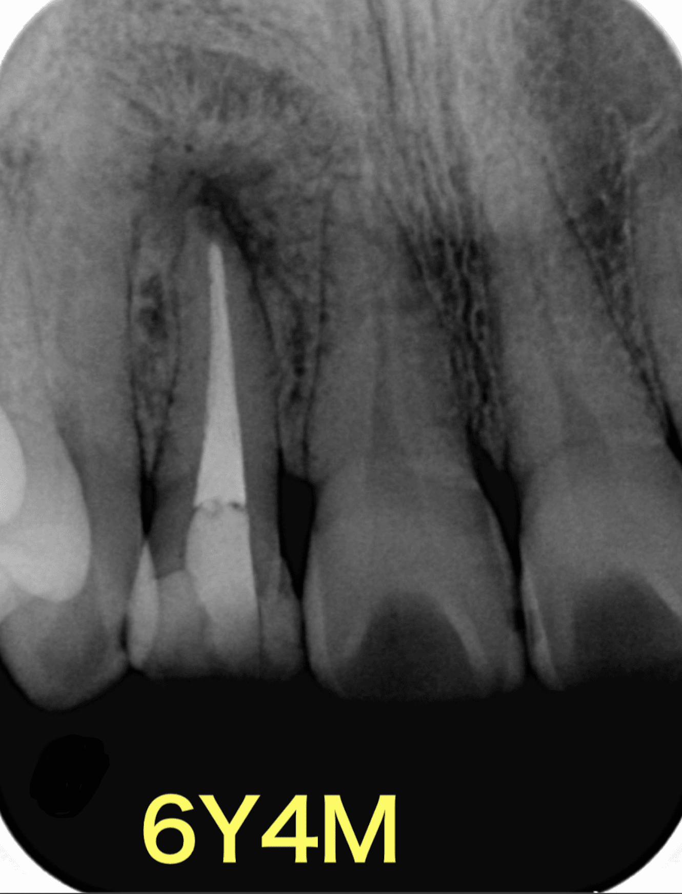再根管治療８年後の経過
