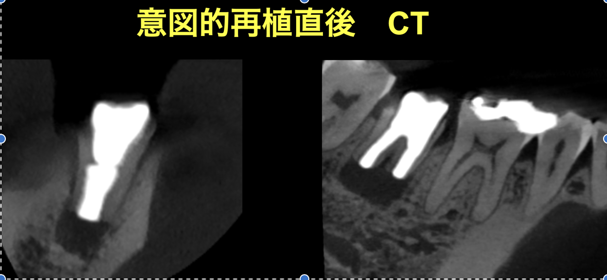 意図的再植術　１年６ヶ月後の経過