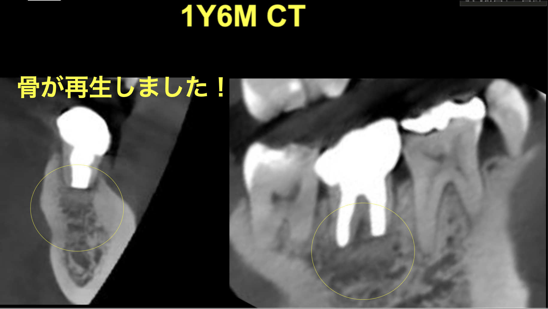 意図的再植術　１年６ヶ月後の経過