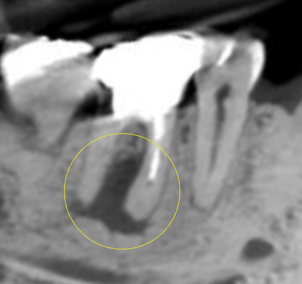 右下６番歯根端切除術　