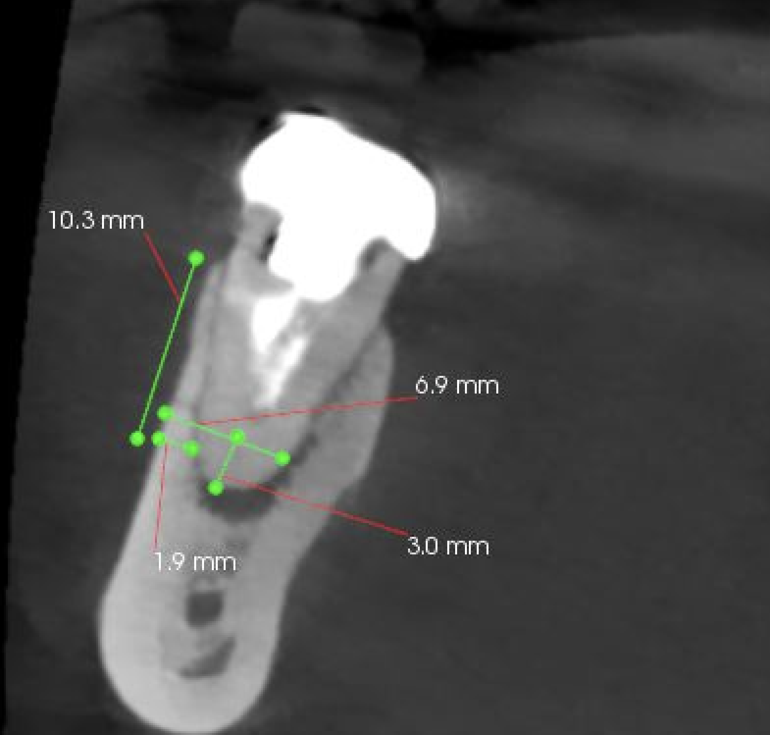 右下６番歯根端切除術　