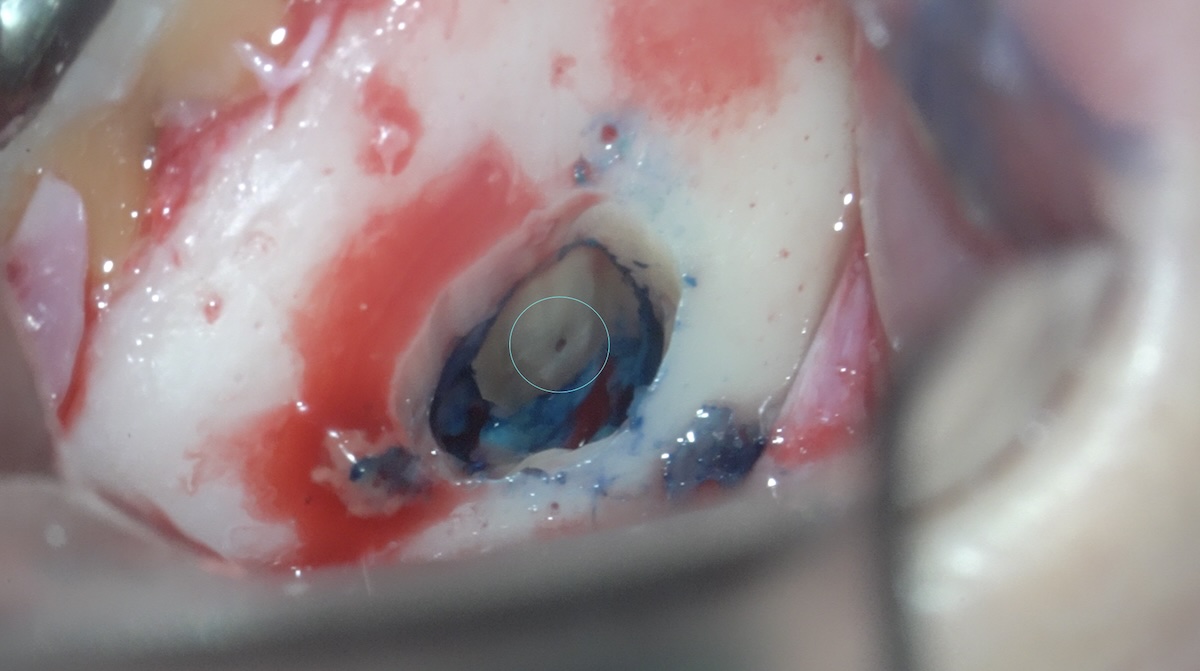 根尖３m m切断後の断面画像。根管の確認。