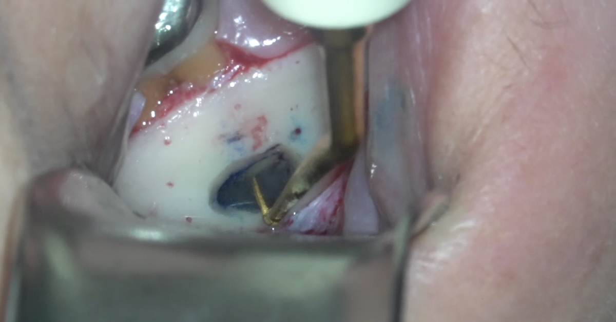 マイクロスコープ下での逆根管形成