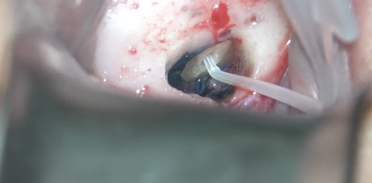 逆根管充填。まずはシーラー填入直前の画像。