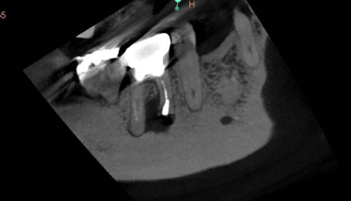 右下６番歯根端切除術　
