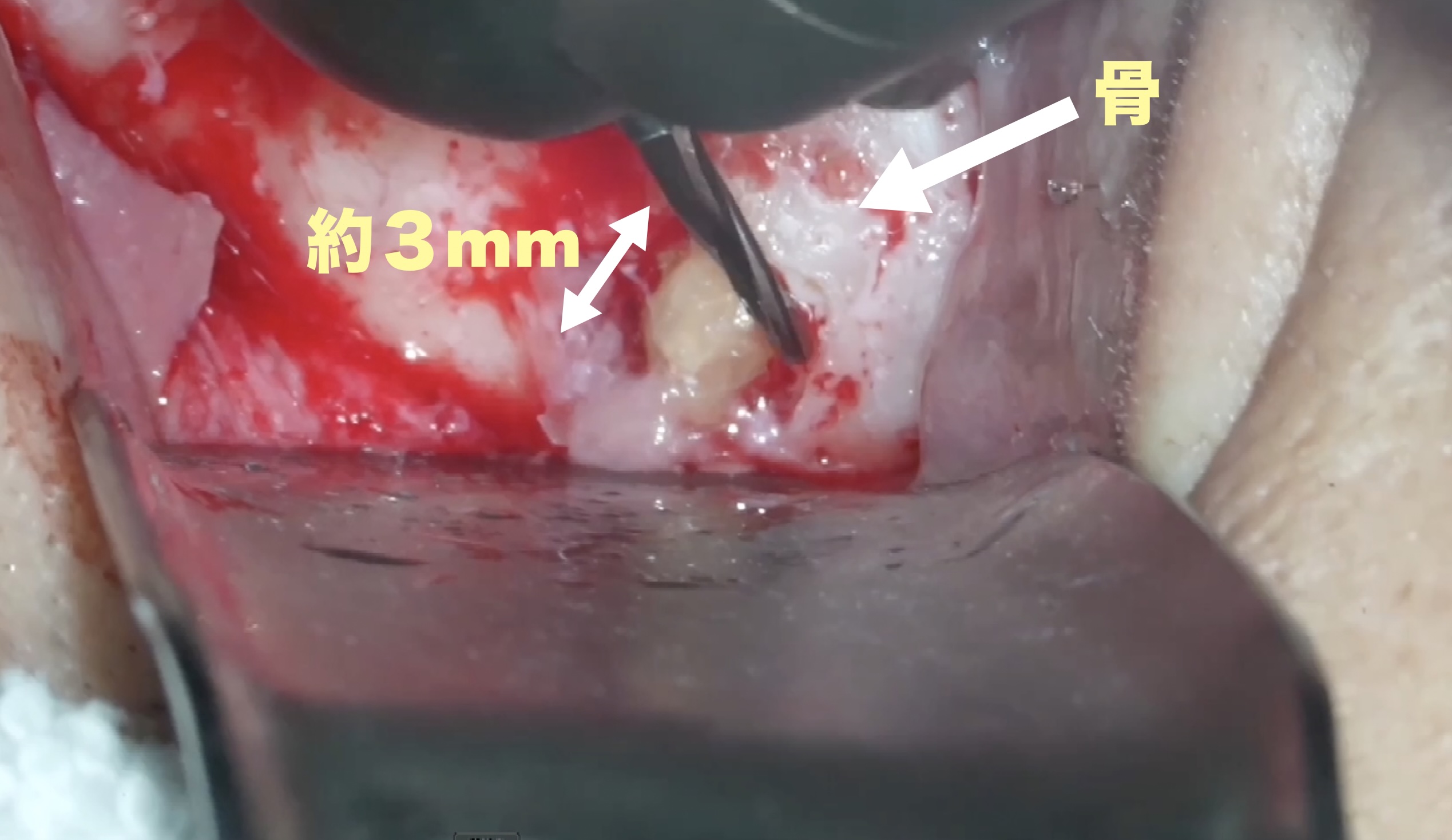 腫れを繰り返した奥歯(右上６番)。歯根端切除術で保存した症例。9ヶ月後の経過。