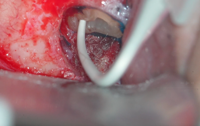 腫れを繰り返した奥歯(右上６番)。歯根端切除術で保存した症例。9ヶ月後の経過。