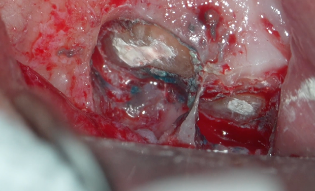 逆根管充填🟰しっかりと封鎖　