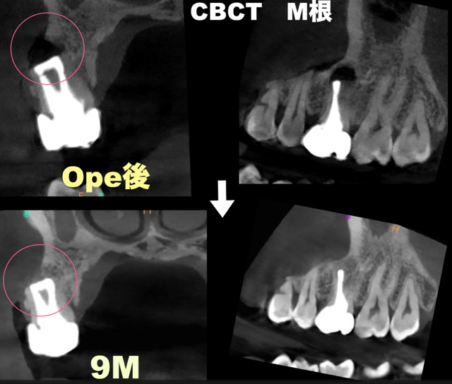 逆根管充填🟰しっかりと封鎖　