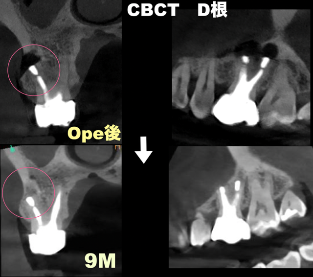 腫れを繰り返した奥歯(右上６番)。歯根端切除術で保存した症例。9ヶ月後の経過。