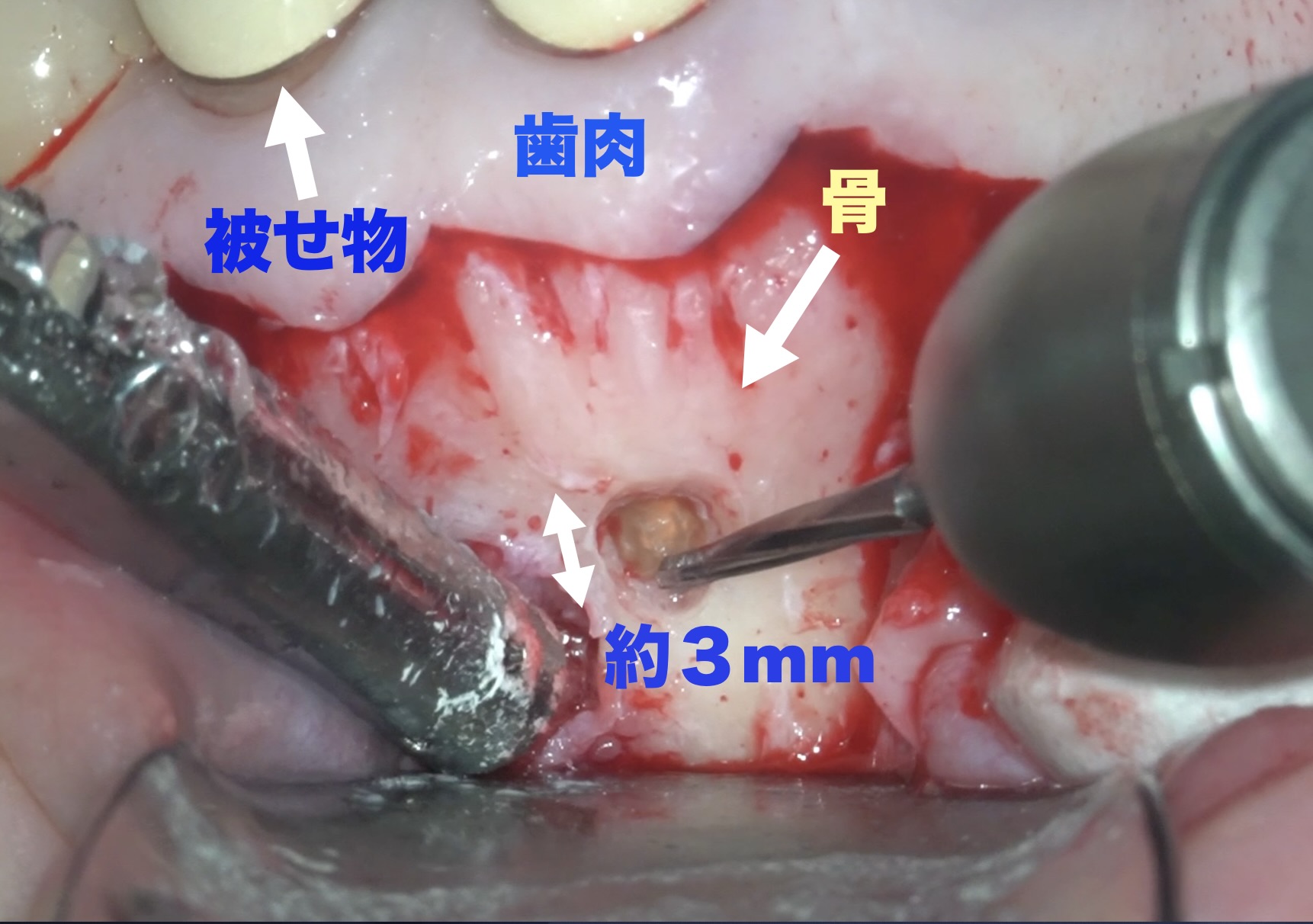２本同時の歯根端切除術　５ヶ月後の経過観察。順調に骨が回復してきており、経過は良好です。