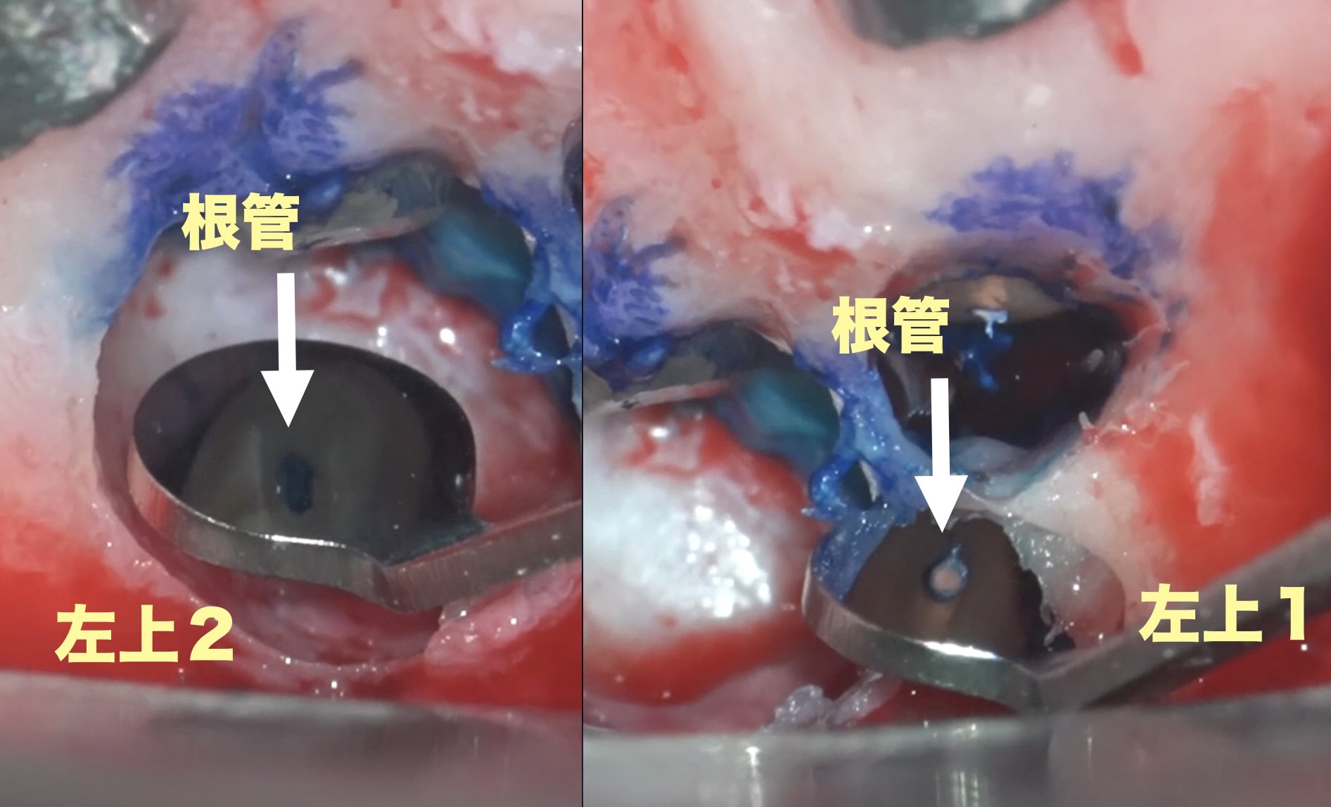 ２本同時の歯根端切除術　５ヶ月後の経過観察。順調に骨が回復してきており、経過は良好です。