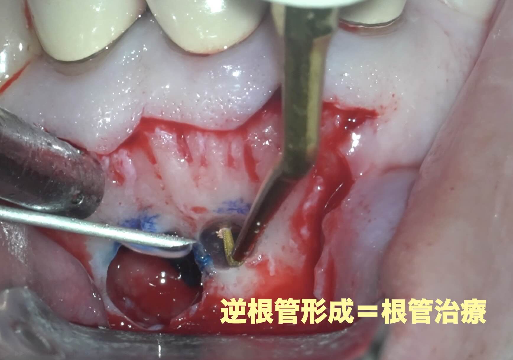 ２本同時の歯根端切除術　５ヶ月後の経過観察。順調に骨が回復してきており、経過は良好です。