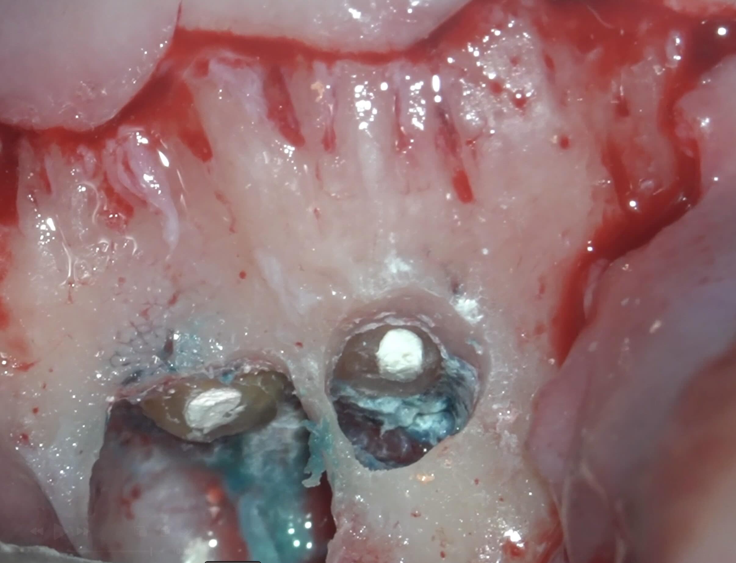 ２本同時の歯根端切除術　５ヶ月後の経過観察。順調に骨が回復してきており、経過は良好です。