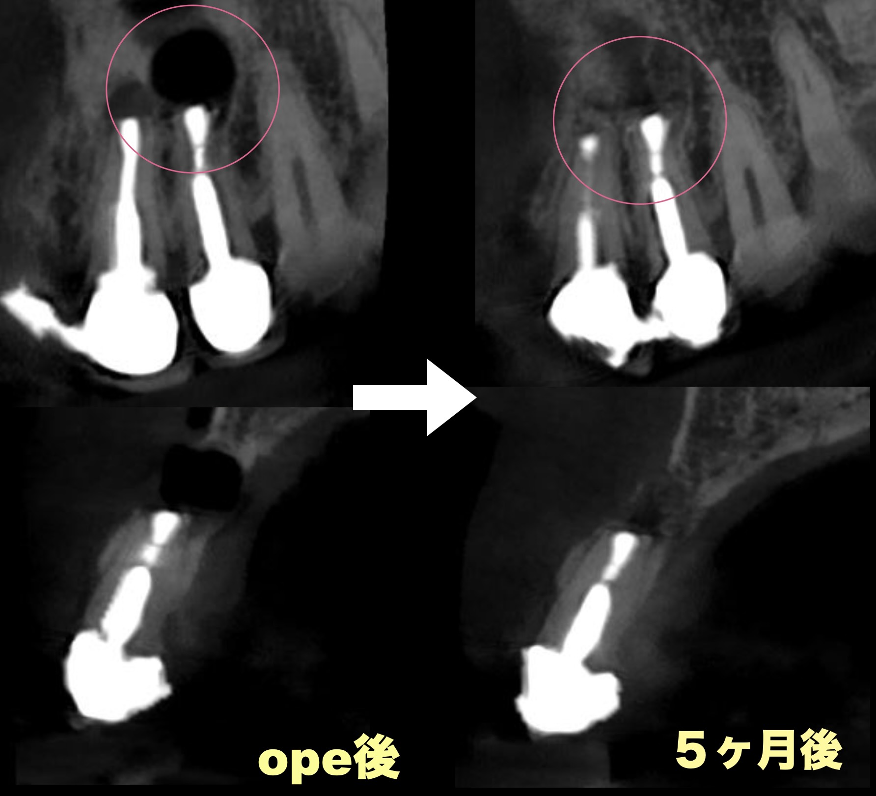 ２本同時の歯根端切除術　５ヶ月後の経過観察。順調に骨が回復してきており、経過は良好です。