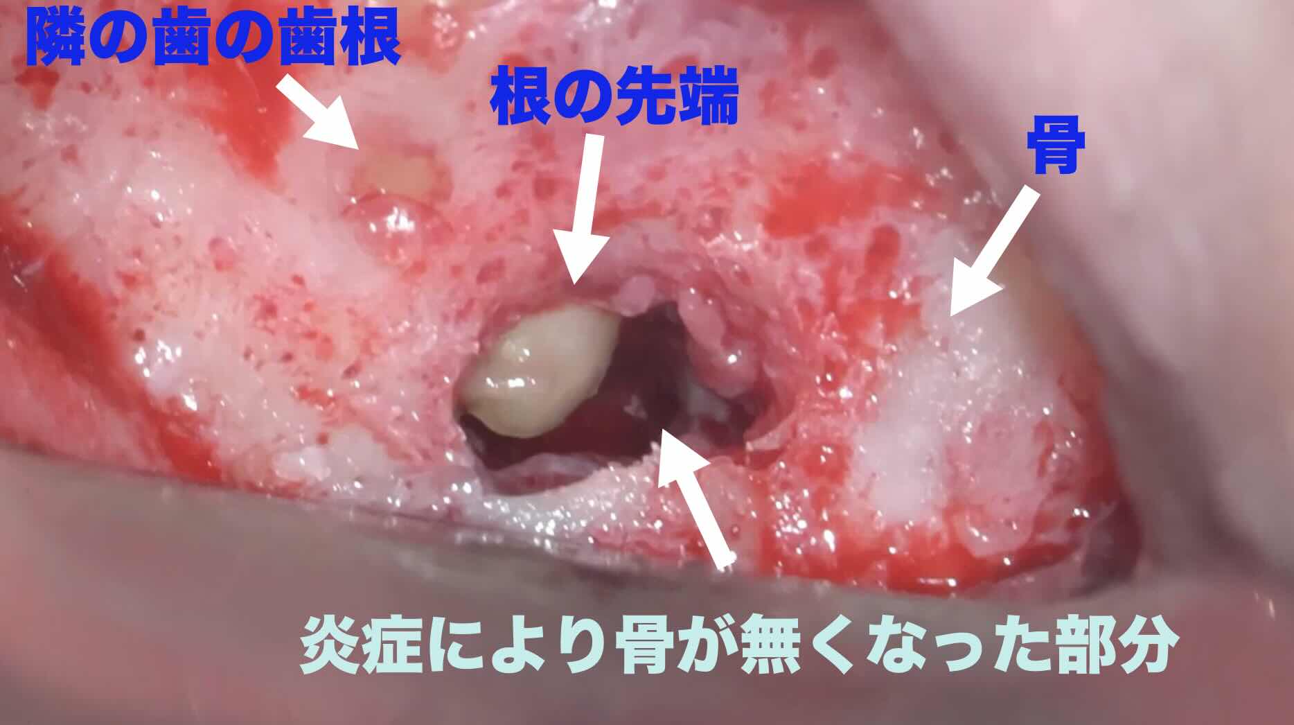 歯根の先端を出して、確認します