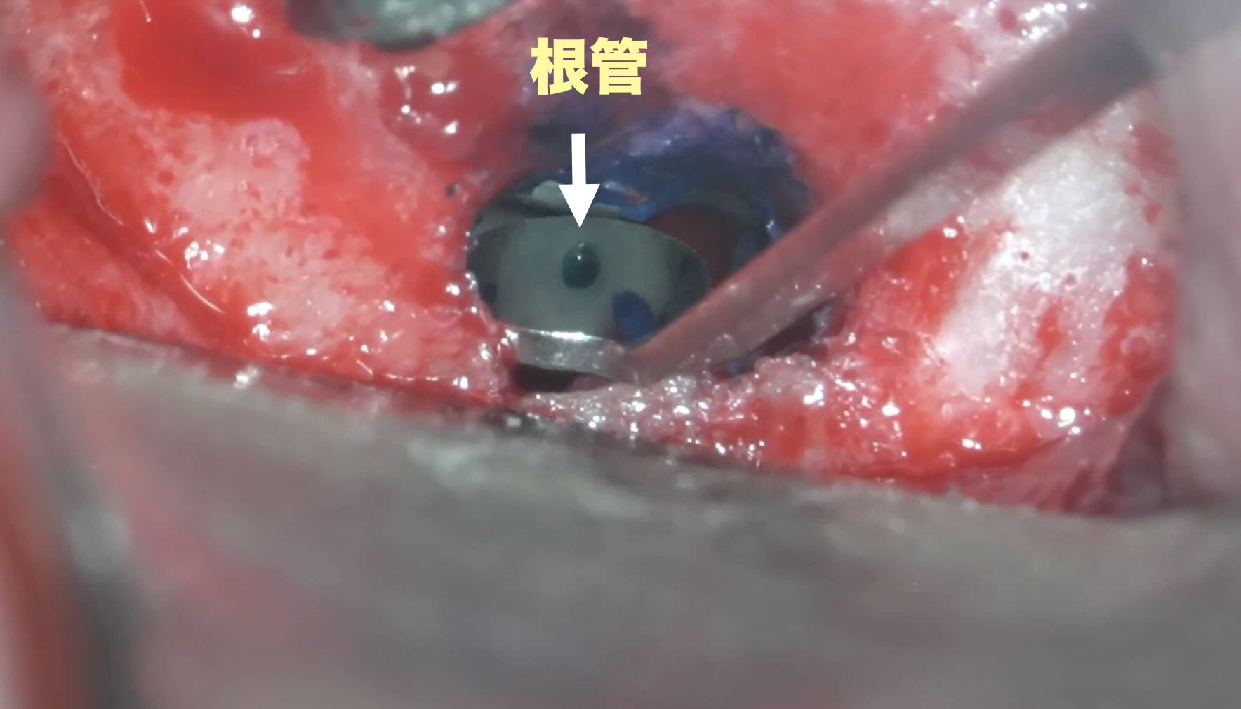 歯根の先端を出して、確認します