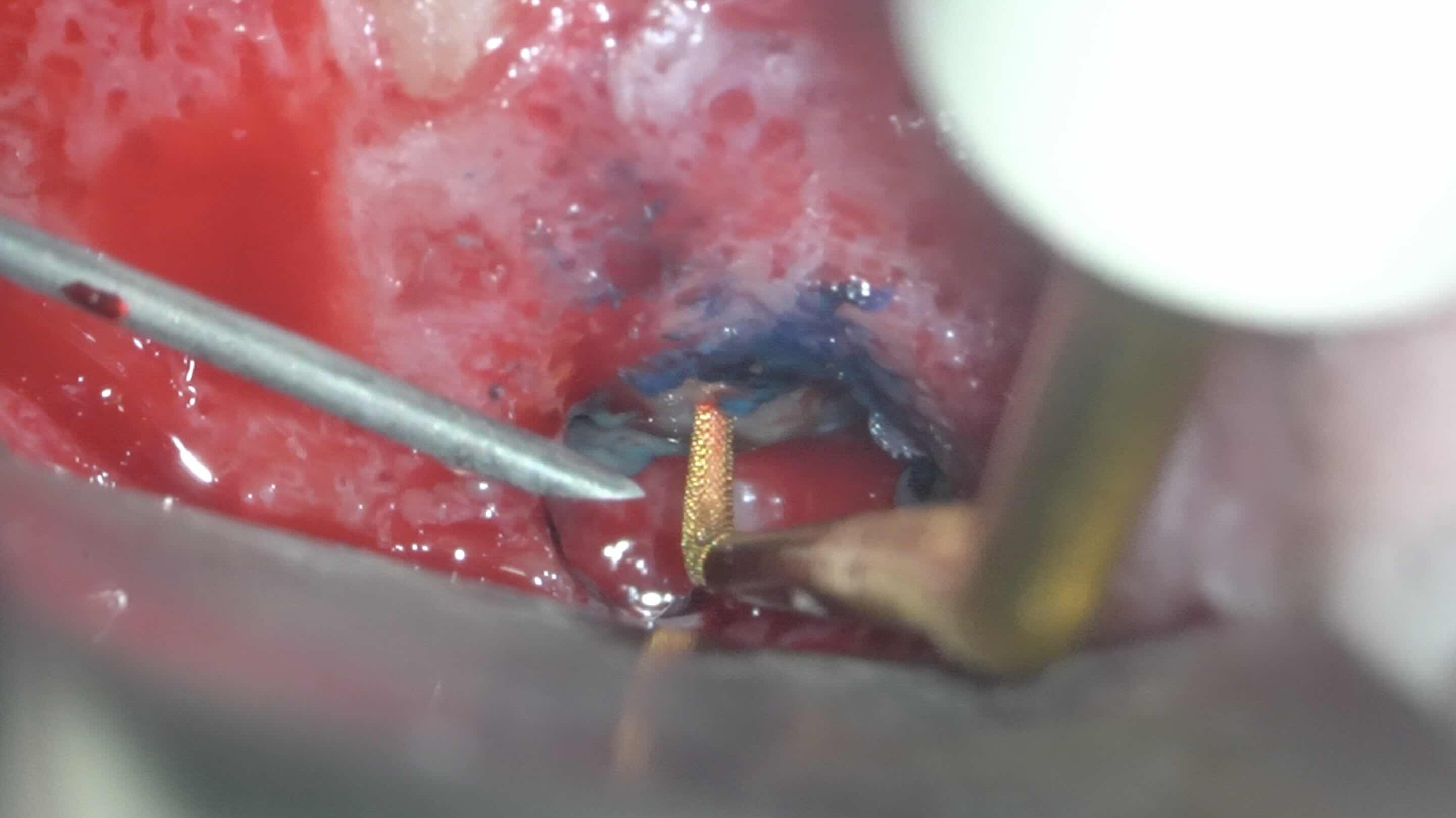 歯肉の腫れと、強い痛みを伴う歯に対する歯根端切除術 