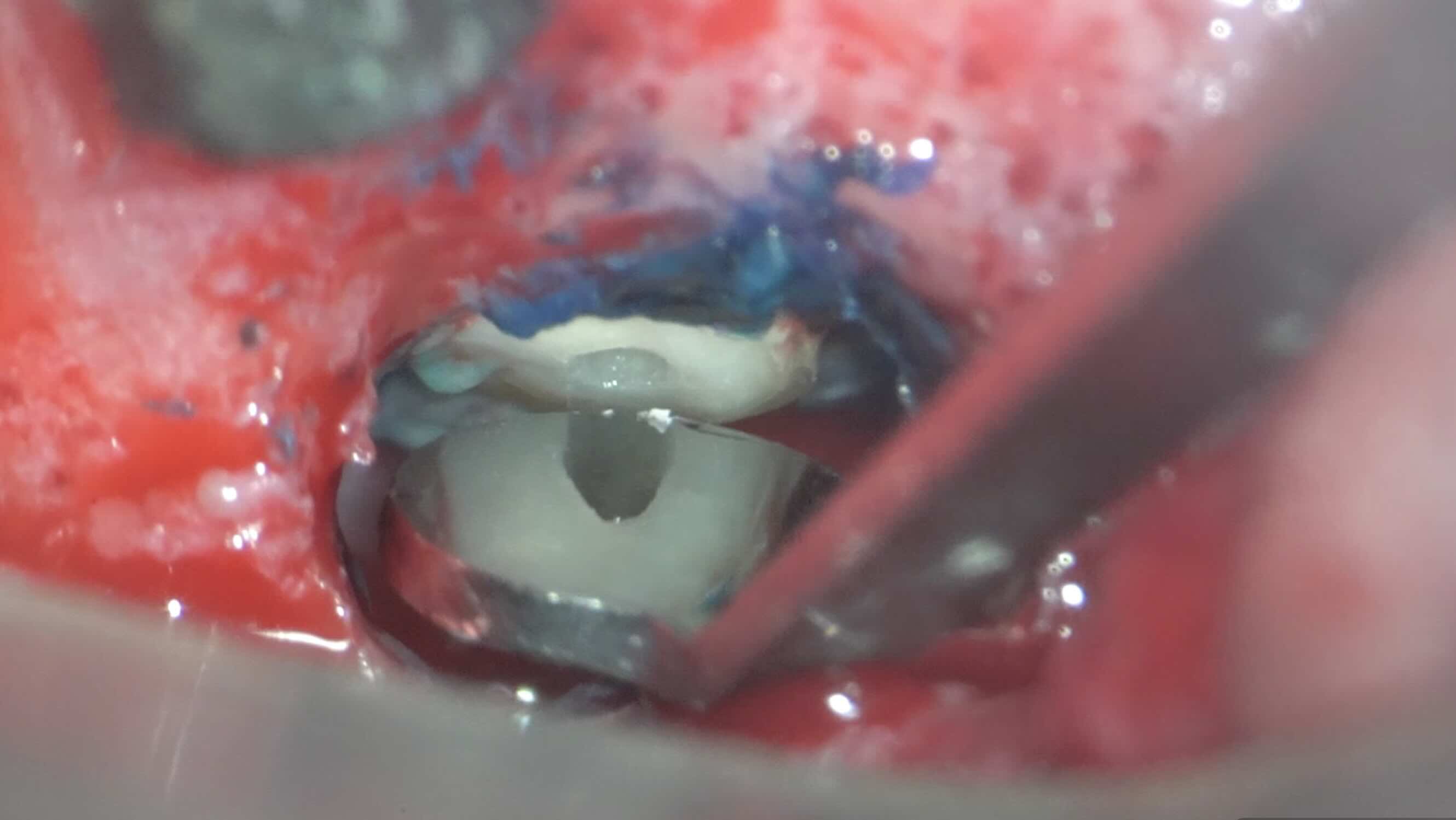 歯肉の腫れと、強い痛みを伴う歯に対する歯根端切除術 