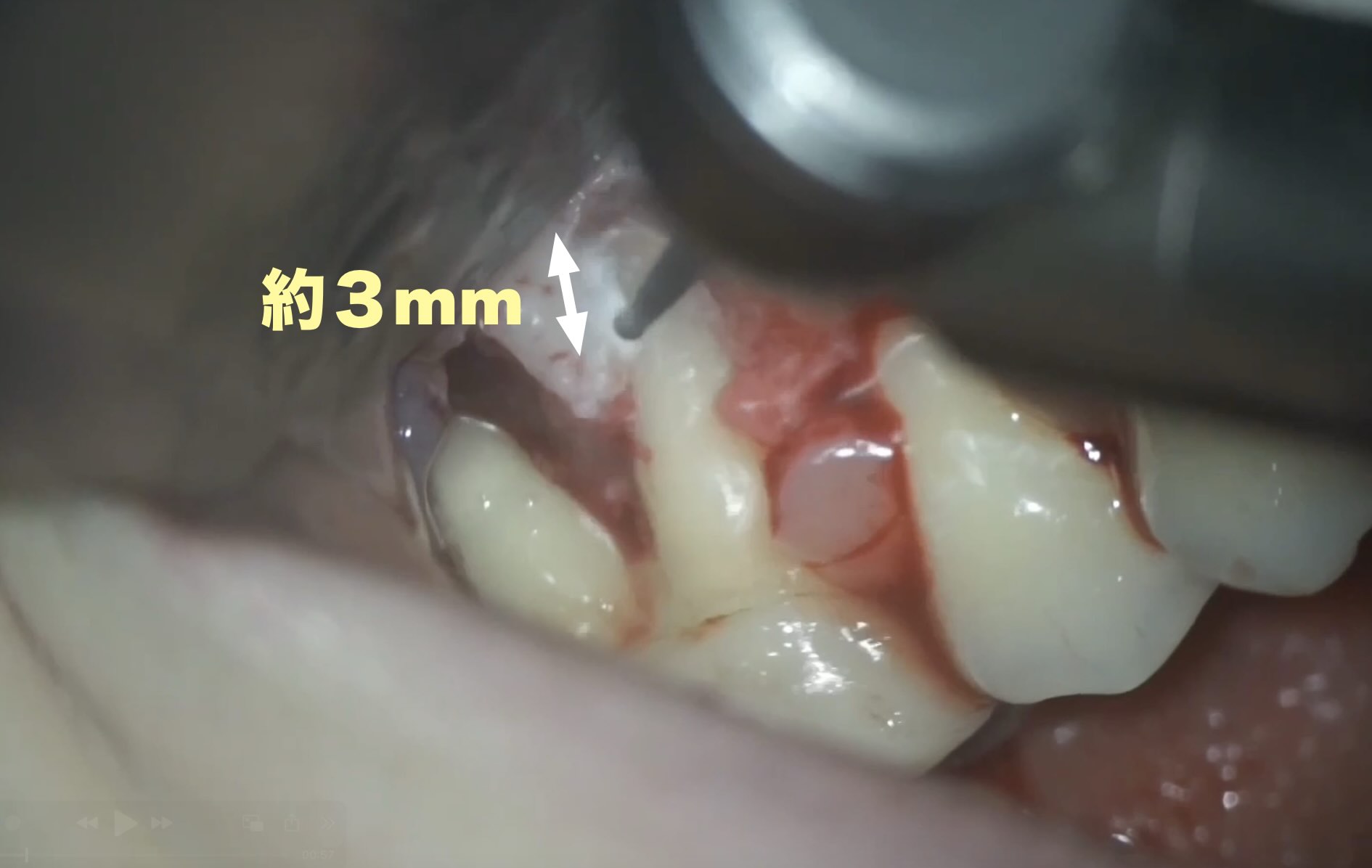 3年後の経過報告