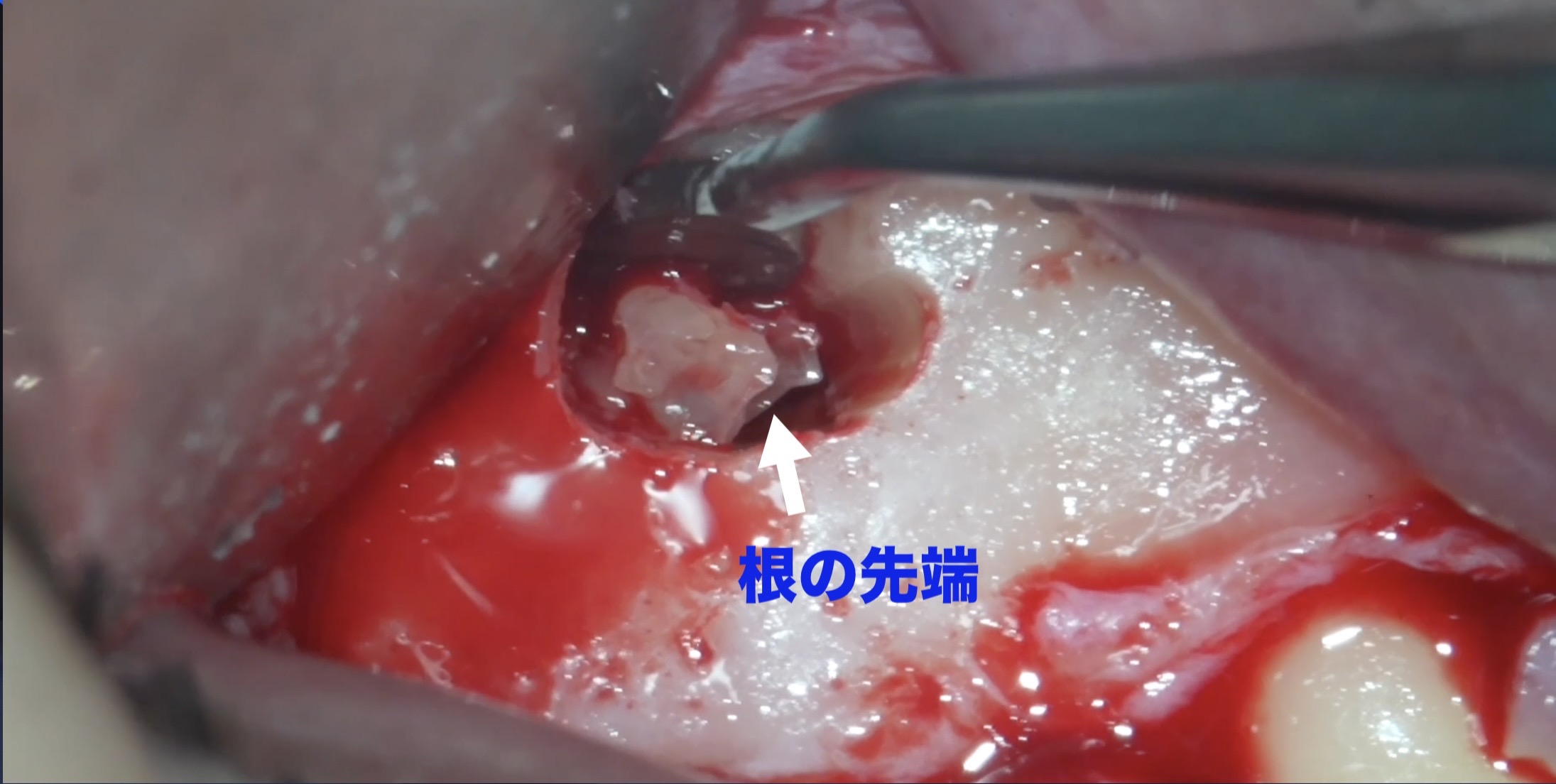 このレントゲン画像を見るに、歯根にヒビが入っていると言われてもおかしくはない。。が、実際には、やってみないと分からない。