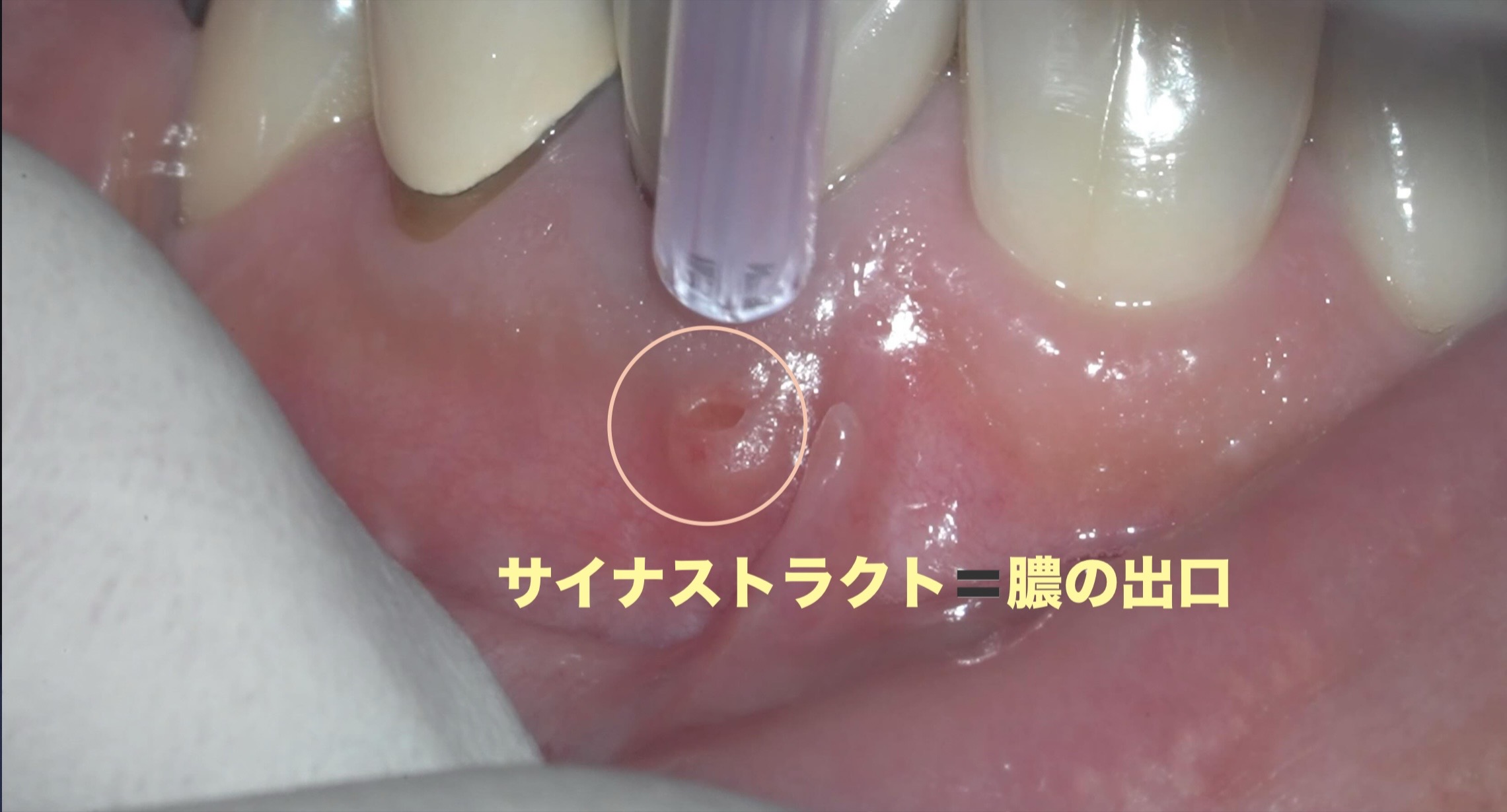 足掛け30年に渡る根の問題。2本同時の歯根端切除術