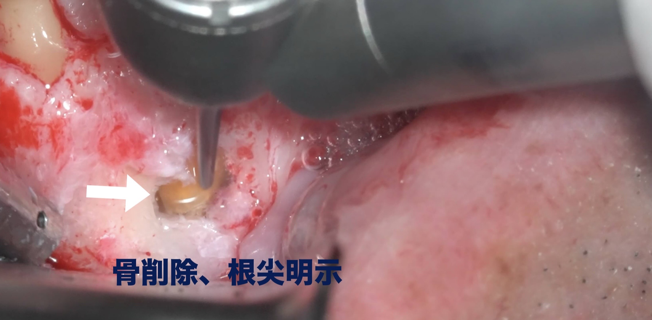 足掛け30年に渡る根の問題。2本同時の歯根端切除術