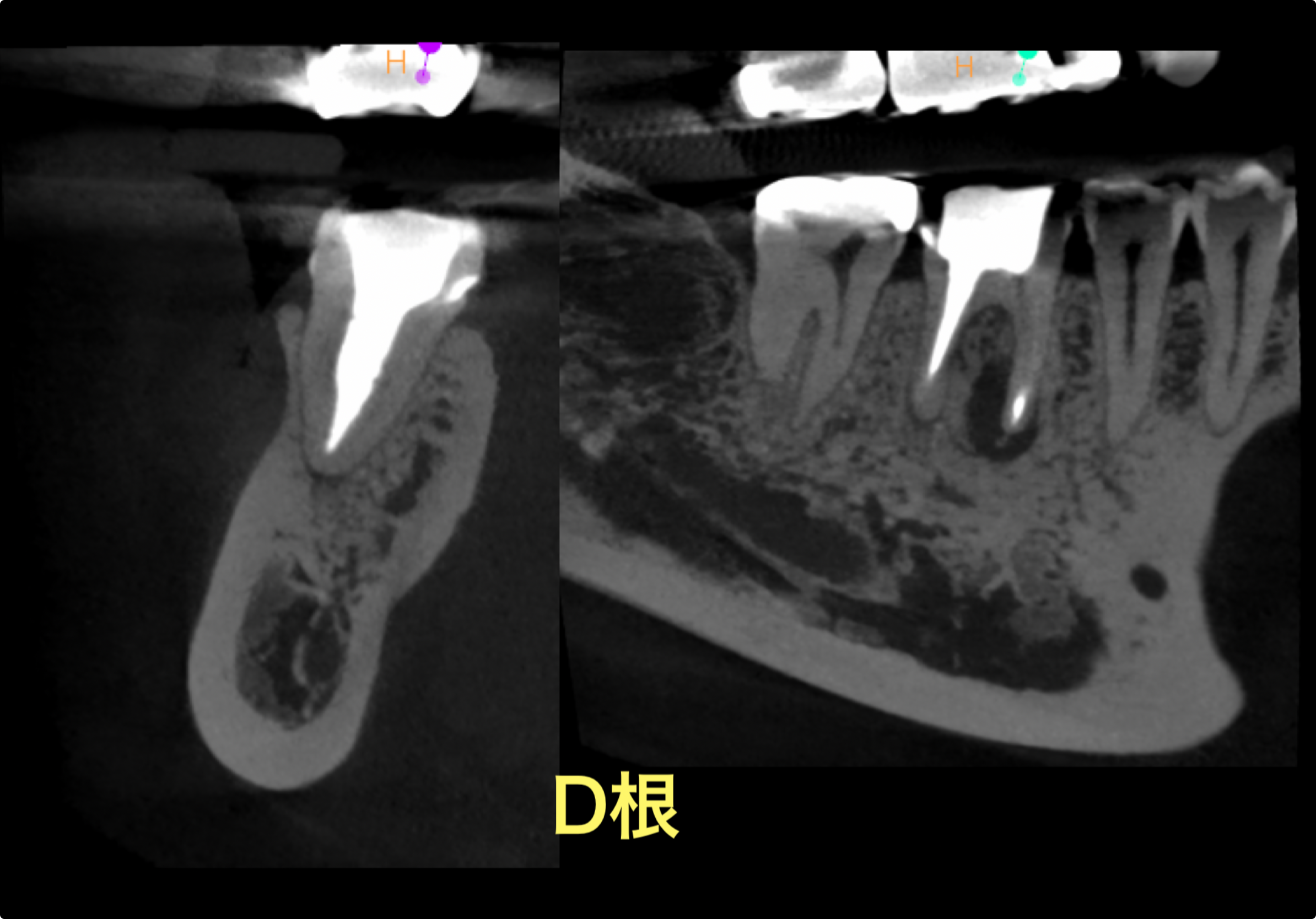 #30(右下6番)再根管治療　2024.3.6