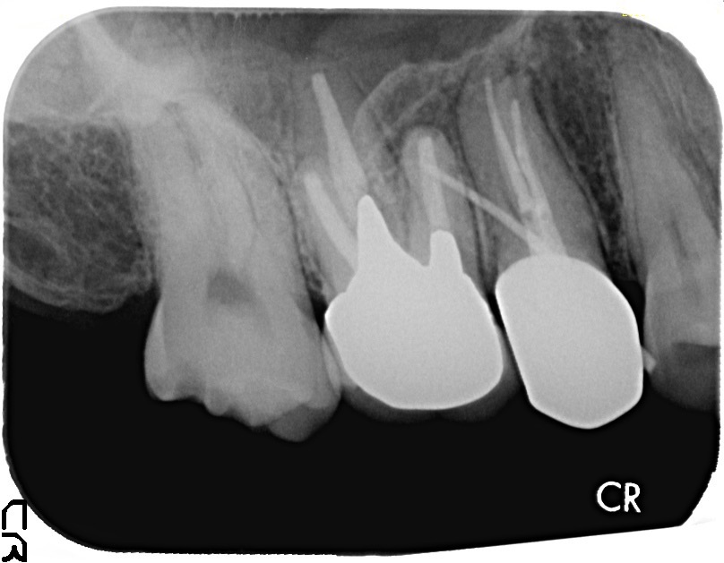 #3(右上6番)歯根端切除術の１年４ヶ月予後