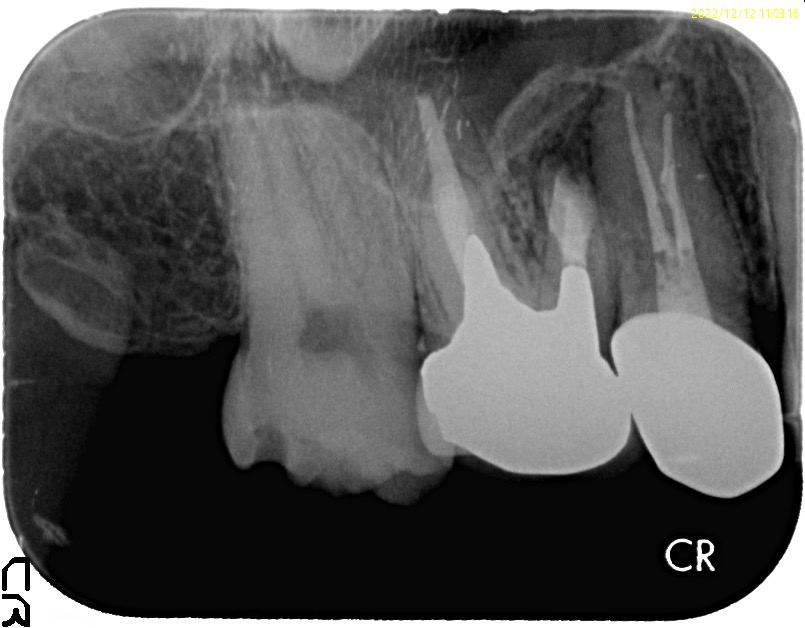 #3(右上6番)歯根端切除術の１年４ヶ月予後